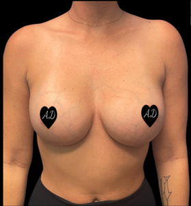 Breast Augmentation